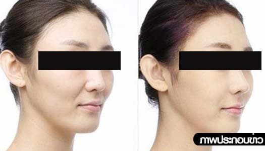 ส.แพทย์ผิวหนัง เตือนฉีดฟิลเลอร์ เสี่ยงตาบอด-เนื้อตาย