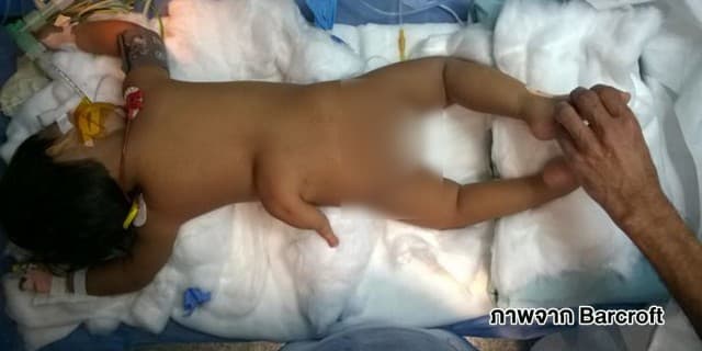 แพทย์อินเดียประสบความสำเร็จในการช่วยเหลือ 'หนูน้อย 3 ขา'