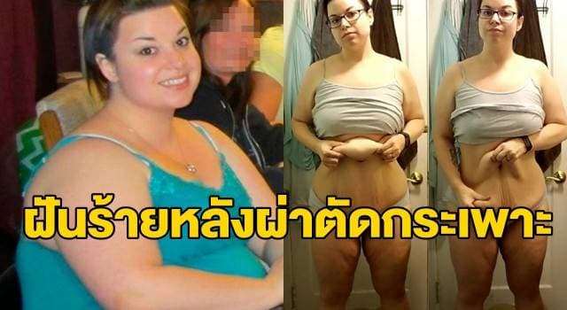 สาวมะกันอ้วน 140 กก. แชร์ประสบการณ์หมดเงินกว่า 3 ล้านผ่าตัดกระเพาะให้ผอม แต่กลับต้องเจอกับฝันร้าย