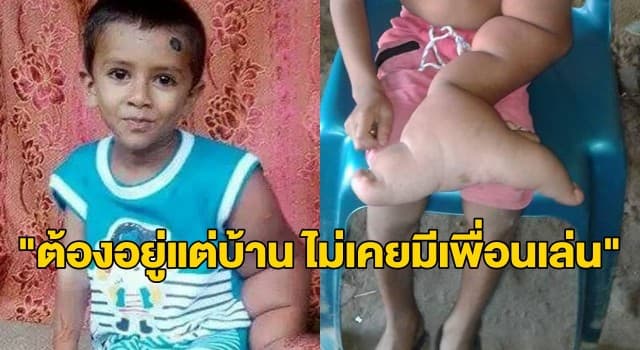 สุดอาภัพ! เด็กบังคลาเทศ 5 ขวบ ป่วยมือยักษ์ โดนชาวบ้านรังเกียจเพราะเชื่อว่าเป็นปีศาจ