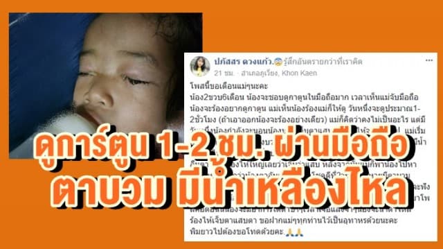 อุทาธรณ์! พ่อแม่ให้ลูกน้อย วัย 2 ขวบ ดูการ์ตูน 1-2 ชม. ผ่านมือถือ ตาบวม มีน้ำเหลืองไหล หมอชี้เป็นตาอักเสบ     