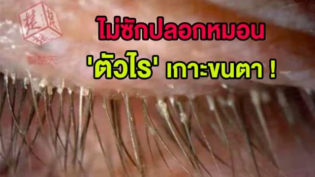 หญิงจีนไม่ซักปลอกหมอน 5 ปี แพทย์ตรวจพบ 'ตัวไร' กว่า 100 ตัว ในขนตา