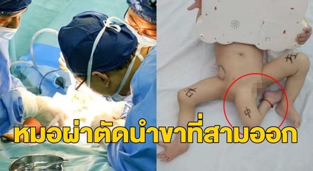 ทีมแพทย์จีนผ่าตัด 10 ชม. ช่วยทารกเกิดมามีขา 3 ข้าง ชี้เป็นของ ‘แฝดปรสิต’