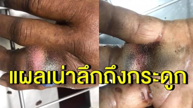 ยังไม่ต้องตัดนิ้วทิ้ง! ลุงวัย 58 ปี แหวนติดนิ้วเอาไม่ออก นิ้วบวมเป่ง แผลเน่าลึกถึงกระดูก กู้ภัยรุดช่วยเหลือ