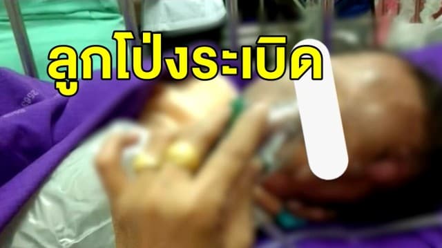 สุดช็อก เด็กหญิง 2 ขวบ ถือลูกโป่งอัดแก๊สใกล้เตากล้วยทอด เกิดระเบิดใส่เผาตัวไหม้