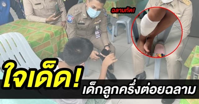 ใจเด็ด! เด็กลูกครึ่งต่อยฉลาม หลังถูกกัดขา แผลเหวอะเย็บ 33 เข็ม