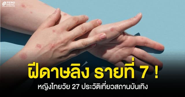 ฝีดาษลิงรายที่ 7 ! พบเพิ่มในไทย เป็นหญิงวัย 27 ปี พบเที่ยวสถานบันเทิง