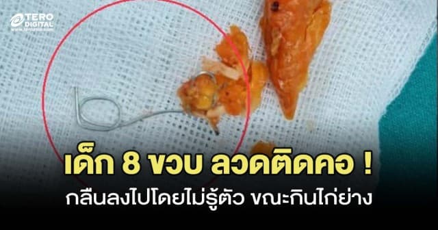 เตือนภัย ! เด็ก 8 ขวบ กลืนลวดมัดไก่ย่าง ติดหลอดอาหาร 