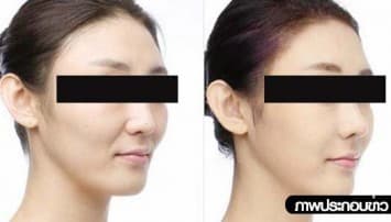 ส.แพทย์ผิวหนัง เตือนฉีดฟิลเลอร์ เสี่ยงตาบอด-เนื้อตาย