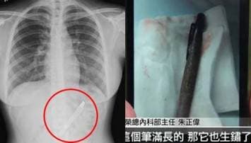 สาวไต้หวันหวิดดับ หลังกลืนปากกาหมึกซึมยาว4นิ้วลงท้อง