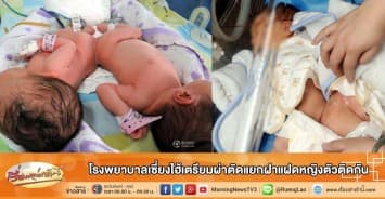 โรงพยาบาลเซี่ยงไฮ้เตรียมผ่าตัดแยกฝาแฝดหญิงตัวติดกัน