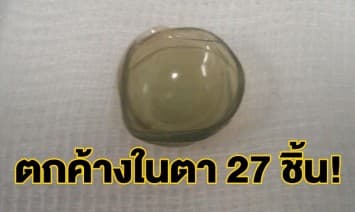 สยอง พบคอนแทคเลนส์ 27 ชิ้น ตกค้างในตาคนไข้หญิงวัย67  
