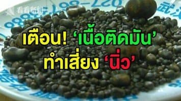 (คลิป) แพทย์จีนเจองานหนัก! ผ่านิ่ว 800 ก้อน ออกจากท้องอาม่า เตือนลดทานเนื้อสัตว์ติดมัน