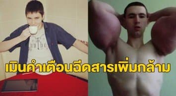 หนุ่มรัสเซียฉีดสารเพิ่มไซซ์กล้ามใหญ่ยักษ์เหมือน ‘ป๊อปอาย’ หมอเตือนเสี่ยงเป็นอัมพาต