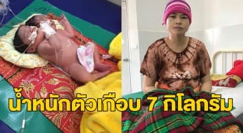 สาวกัมพูชาช็อก คลอดลูกแฝดมี 2 หัวในร่างเดียว เผยตอนท้องไม่เคยอัลตราซาวด์