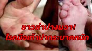 ชาวลำปางผวา! โรคมือเท้าปากระบาดหนัก พบเด็กป่วย 317 ราย 