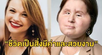 สาวสหรัฐฯ รู้ซึ้งคุณค่าชีวิตหลังยิงตัวตายแต่รอด ก่อนปลูกถ่ายใบหน้าใหม่สำเร็จ