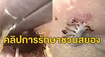 สยอง! นาทีแพทย์มาเลย์ดึง ‘เห็บ’ ตัวเป็นๆ ออกจากรูหูคนไข้