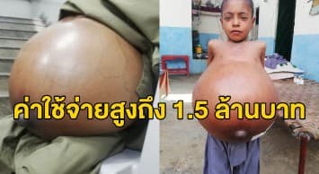 ด.ช.ปากีฯ 9 ขวบ ป่วยโรคตับเรื้อรัง แบกท้องโตรอความหวังได้ปลูกถ่ายตับรักษาชีวิต