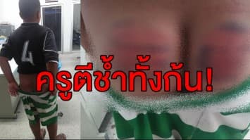 แม่โวย! ครูโหดใช้ไม้เรียวตีลูก ป. 6 ช้ำทั้งก้น ลั่นเอาเรื่องถึงที่สุด 