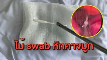 อุทาหรณ์! แหย่ไม้ swab ผิดวิธี ไม้หักคาโพรงจมูก ต้องให้หมอคีบออกมาให้