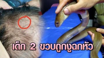 อุทาหรณ์! เด็ก 2 ขวบ ถูกงูเห่าฉกหัว คาดซุกตัวอยู่บนที่นอน ล่าสุดพ้นขีดอันตราย