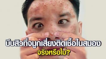 หมอแล็บแพนด้า ไขข้อสงสัย บีบสิวที่จมูก เสี่ยงติดเชื้อในสมอง จริงหรือไม่? เผยพบเคสตัวอย่างที่ประเทศจีน