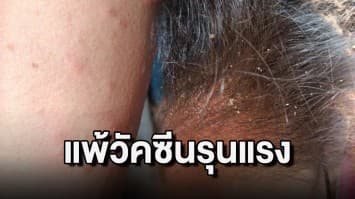 ผญบ. ร้องสื่อ แพ้วัคซีนอย่างรุนแรง คันต่อเนื่อง 8 เดือน โดนปัดรักษา ให้ดูแลตัวเองตามสภาพ