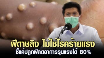 สาธิต ย้ำ ฝีดาษลิง ไม่ใช่โรคร้ายแรง ขอปชช.อย่าตื่นตระหนก ชี้แค่ปลูกฝีลดอาการรุนแรงได้ 80%