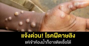 นักไวรัสวิทยาฯ เตือนให้ตั้งรับ โรคฝีดาษลิง แค่เข้าห้องน้ำก็ติดเชื้อได้