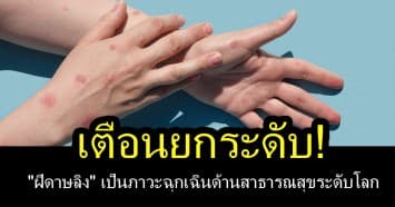 เตือนยกระดับ! "ฝีดาษลิง" เป็นภาวะฉุกเฉินด้านสาธารณสุขระดับโลก