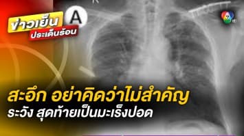 อุทาหรณ์ ! หมอสุรัตน์ โพสต์เตือน “สะอึกไม่หาย” ระวังป่วยเป็นโรคมะเร็งปอด