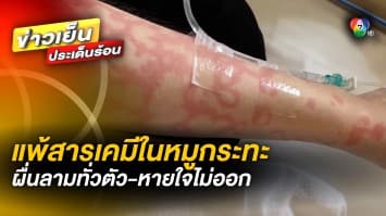 อุทาหรณ์สายปิ้งย่าง ! สาวแพ้สารเคมีใน “หมูกระทะ” ทำผื่นขึ้น-หายใจไม่ออก