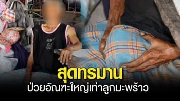 ชายวัย 60 ป่วยอัณฑะใหญ่เท่าลูกมะพร้าว วอนหมอช่วย ยอมตัดลดความทรมาน