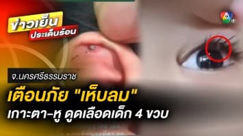 แม่โพสต์เตือนภัย “เห็บลม” อาละวาด โผล่เกาะตา-หู ดูดเลือดหนูน้อย วัย 4 ขวบ