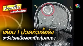 แพทย์เตือน ! ปวดหัวบ่อย รุนแรง เรื้อรัง ระวังป่วย โรคเนื้องอกเยื่อหุ้มสมอง