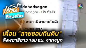 สาวโพสต์ เตือนภัย “สายชอบกินอาหารดิบ” หลังพบพยาธิยาว 180 ซม. ในผู้ป่วย 