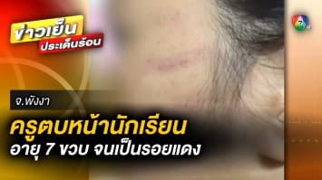 เร่งสอบเข้ม ! ไขปม อ้าง “คุณครู” ตบหน้านักเรียน วัย 7 ขวบ จนเป็นรอยแดง