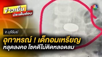 อุทาหรณ์ ! เด็ก 5 ขวบ “อมเหรียญ” โชคดีไม่ติดหลอดลม จ.บุรีรัมย์