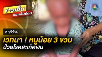 เวทนา ! หนูน้อยวัย 3 ขวบ ป่วย “โรคสะเก็ดเงิน” รักษาหลายแห่งไม่หาย  