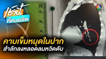 อุทาหรณ์ ! คาบ “เข็มหมุด” ขณะเย็บผ้า สำลักลงหลอดลม หวิดดับ