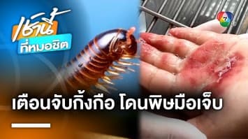 เอ็นดู ! หนูน้อยเผลอไปจับกิ้งกือ โดนพิษเป็นรอยไหม้ กลัวถูกตัดมือ