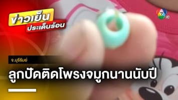 อุทาหรณ์ ! “ลูกปัด” ติดโพรงจมูกเด็ก 7 ขวบ นานนับปี จ.บุรีรัมย์