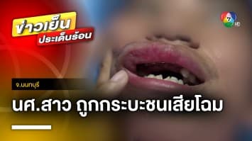 เปิดใจ ! นักศึกษาสาว ถูกรถกระบะชนฟันหัก-แขนหัก เย็บ 70 เข็ม จ.นนทบุรี