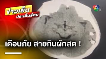 หมอเตือน ! “กินผักสด” ระวังพยาธิขึ้นสมอง แนะล้างให้สะอาดทุกครั้งก่อนกิน