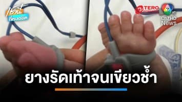 ญาติโวย ! โรงพยาบาลใช้ยางรัดเท้า วัดชีพจรหนูน้อย 6 เดือน จนเขียวช้ำ | เช้านี้ที่หมอชิต