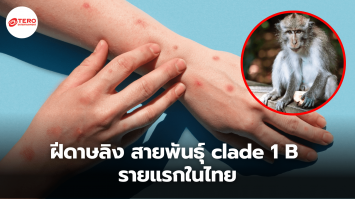 คนแรกในไทย ! พบชายชาวยุโรปติดเชื้อ ฝีดาษลิง สายพันธุ์ clade 1 B