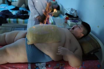 เผยภาพหวาดเสียว เด็กจีนป่วยโรคอ้วนหนักเกือบ 150 กิโล ทำทรีทเมนท์วางเปลวไฟบนหน้าท้อง