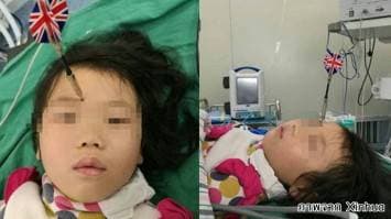 เด็กจีนเล่นพิเรนทร์ปาลูกดอกปักหน้าผากน้องสาววัย 6 ขวบ หวิดตาบอด