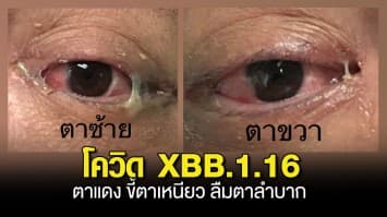  หมอมนูญ ยกเคสชายไทยติด โควิด XBB.1.16 ตาแดง ขี้ตาเหนียว ลืมตาลำบาก ตรวจพบเชื้อหลังกลับจาก ตปท.